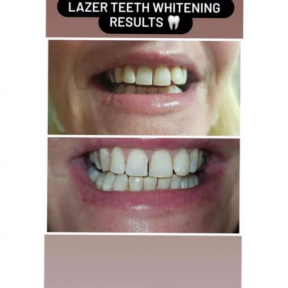 89 euro dental grade laser teeth whitening